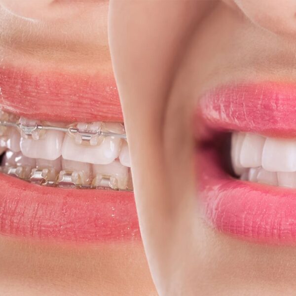 Teeth Misalignment Aligners vs Braces, which is the better option